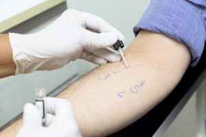 Prick-Test zur Allergie-Diagnostik bei Hautarzt Dr. Kirschner