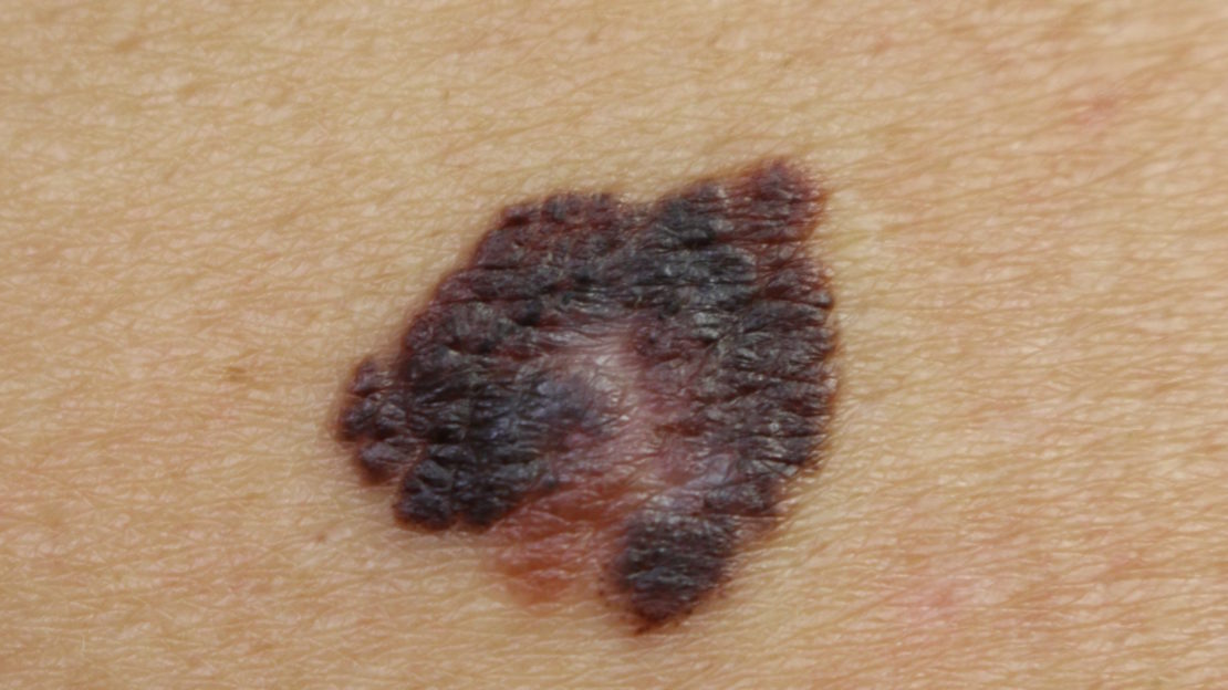 Muttermale keinesfalls mit Laser oder IPL entfernen! Hautarztpraxis Dr. Kirschner