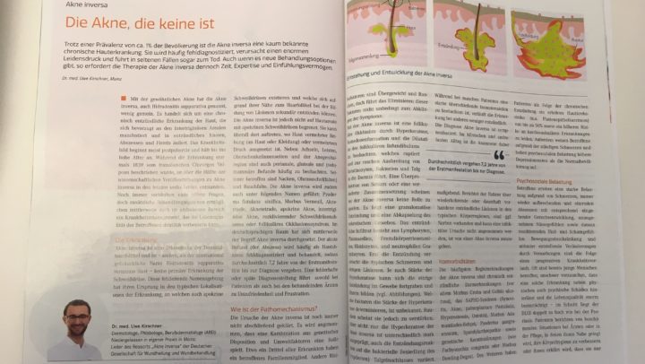 Akne inversa/ Hidradenitis suppurativa Dr. Kirschner Ärztliches Journal Dermatologie