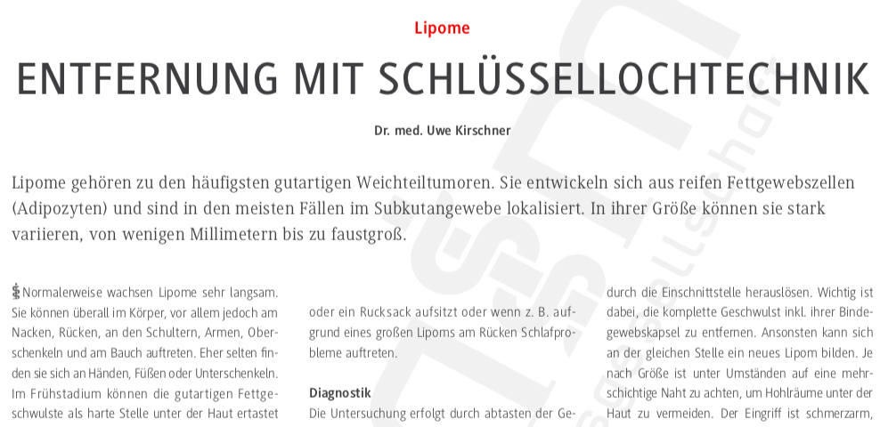 Lipom Entfernung in Mainz mit Schlüsselllochtechnik